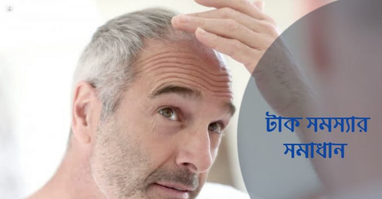 টাক সমস্যার সমাধান
